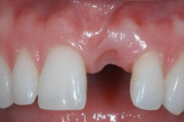 Close-up of front teeth with gap showing dental implant treatment need.
