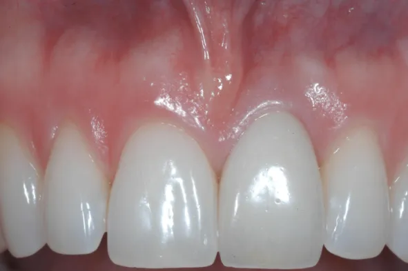 Close-up of bright white dental veneers or crowns on upper front teeth