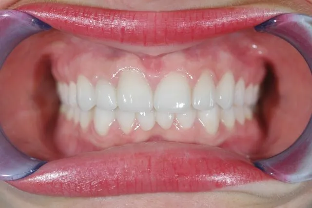 Dental bridge restoration with cheek retractors showing completed bridge work