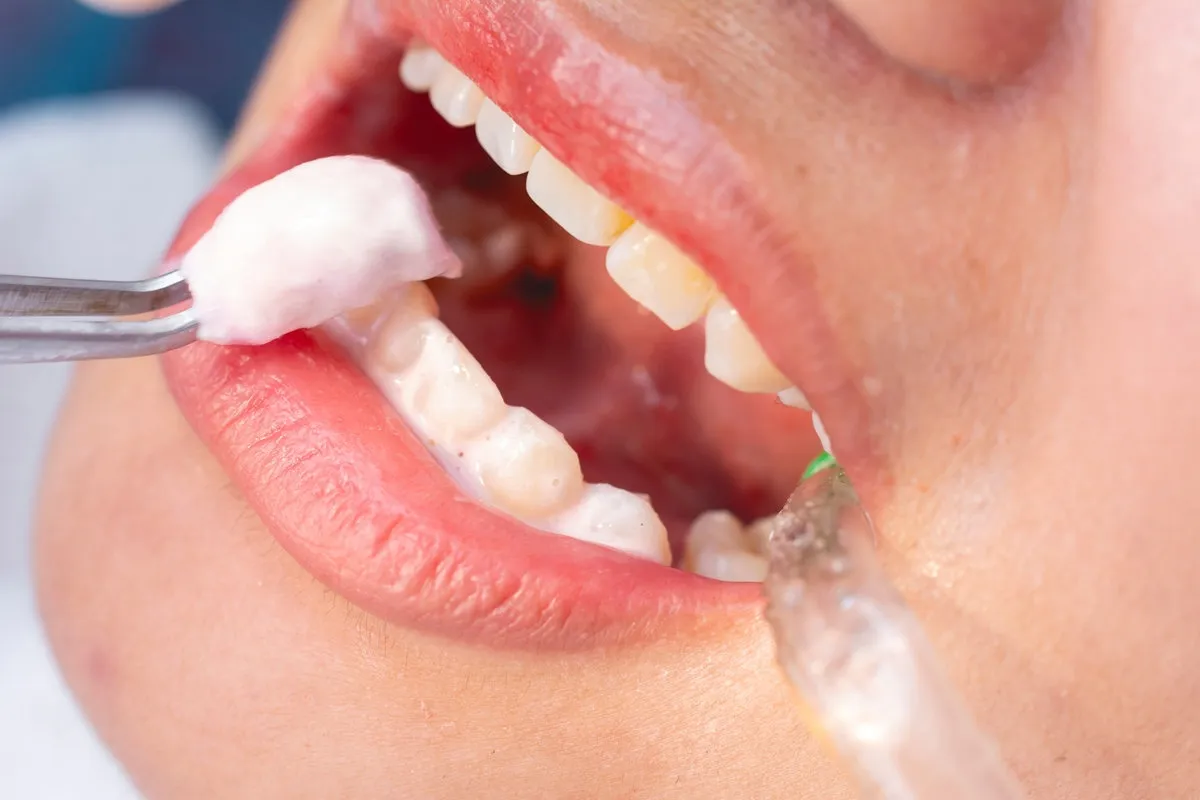 Couple smiling while looking at phone - Sunrise Dental Arts Care A dental professional using tweezers to apply a medicated paste or fluoride gel onto the patient’s teeth. A saliva ejector is present