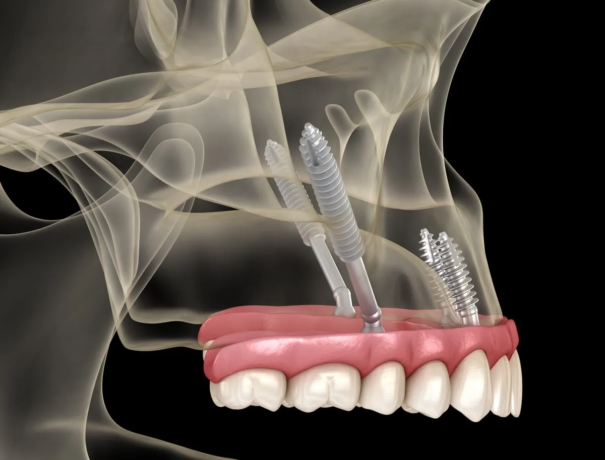 Happy couple smiling outdoors - Sunrise Dental Arts Care Dental implants in a jaw model