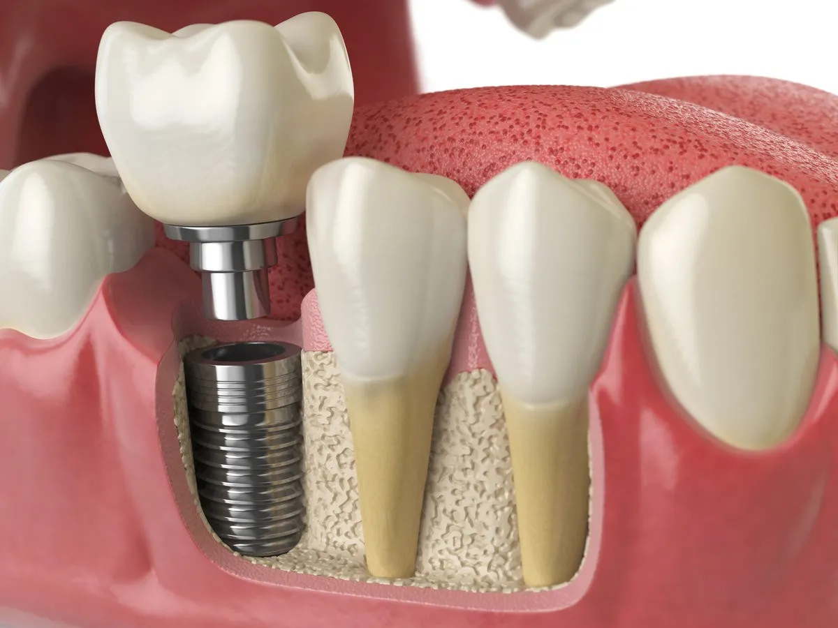 Happy couple smiling outdoors - Sunrise Dental Arts Care Implant crowns