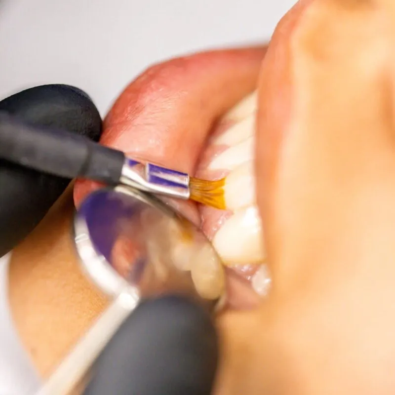 Dental professional applying tooth treatment in clinic
