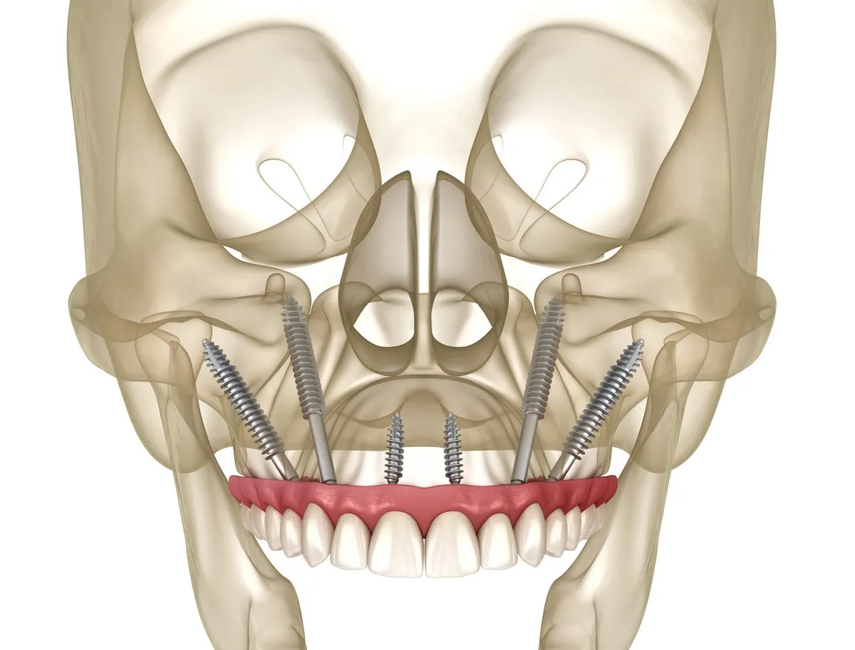 Man pointing at bright smile - Sunrise Dental Arts Care Dental implants in human skull model