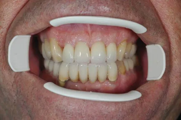 Patient smile showing whitened, restored teeth with dental guides