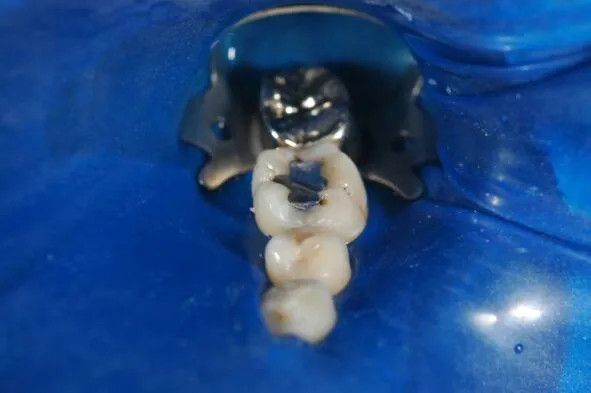 Dental implant model showing tooth restoration after treatment on blue background