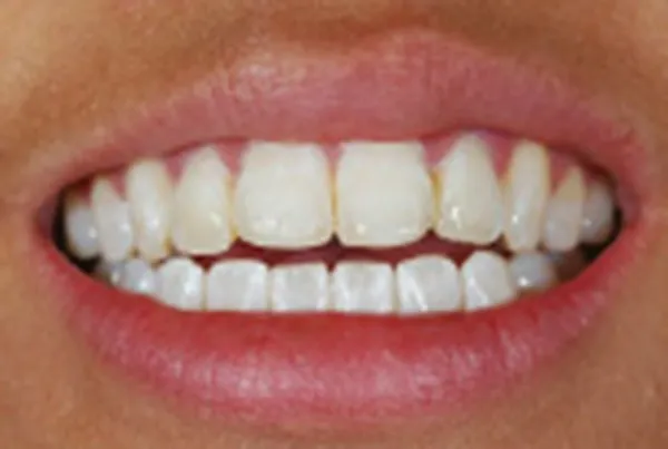 After dental bonding: close-up of smile with restored tooth shape and whiteness
