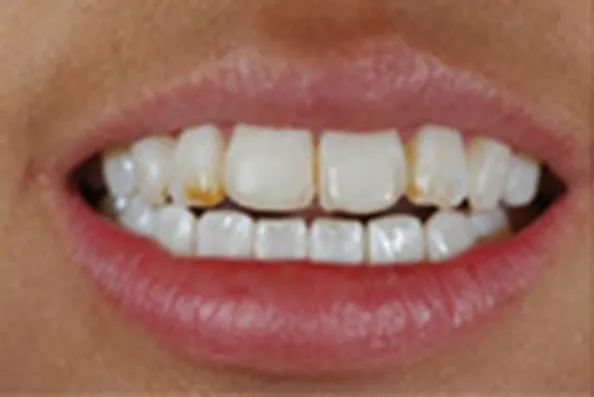Before dental bonding: close-up of teeth with chips and visible damage