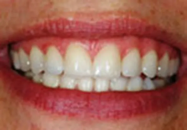 Close-up of bright white porcelain dental crowns on upper teeth after treatment