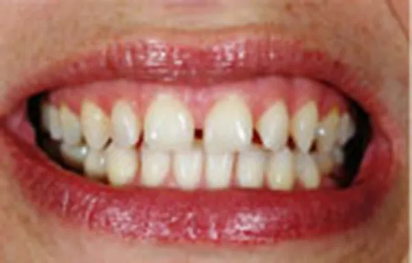 Before photo showing discolored and uneven upper teeth needing crown work