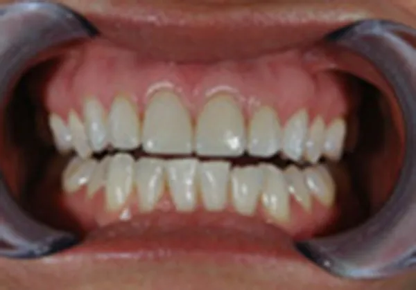After dental veneers: close-up of whitened, evenly spaced upper and lower teeth
