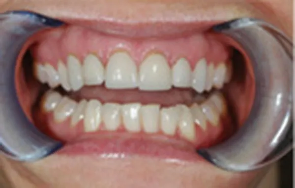 Before dental veneers: close-up of teeth with discoloration and spacing gaps