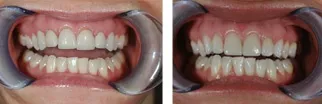 Set of dental veneers displayed on a model showing natural tooth shape and color