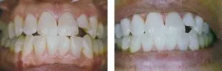 Professional tooth whitening gel being applied during an in-office treatment