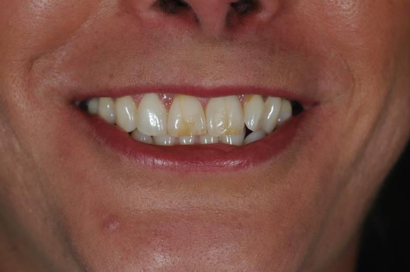 Before-photo of patient smiling with discolored upper front teeth showing staining.
