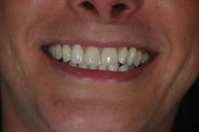 After-photo of patient smiling with whitened and brightened upper front teeth.