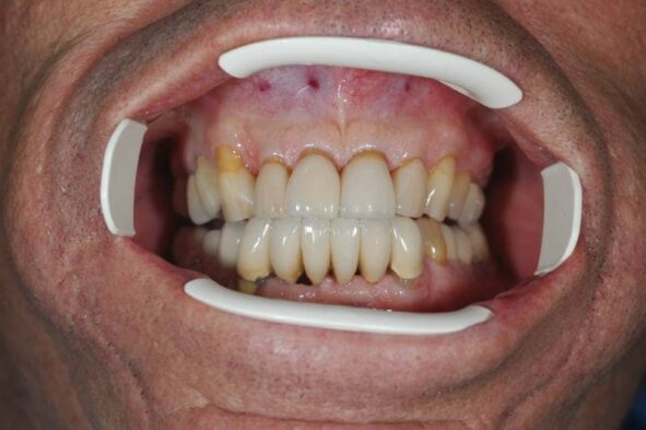 Patient smile showing discolored teeth before whitening treatment with dental guides