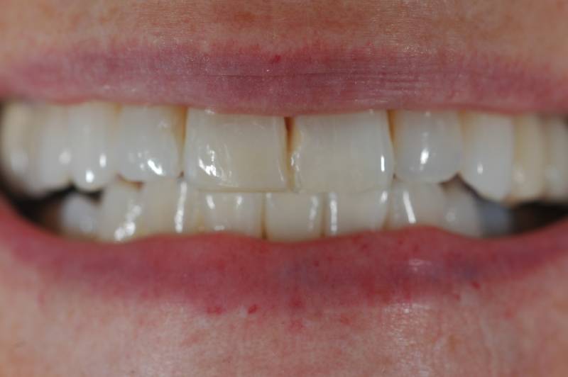After-photo of whitened upper front teeth with improved brightness and uniformity.
