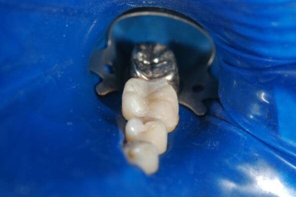 Dental implant model showing tooth before restoration on blue background