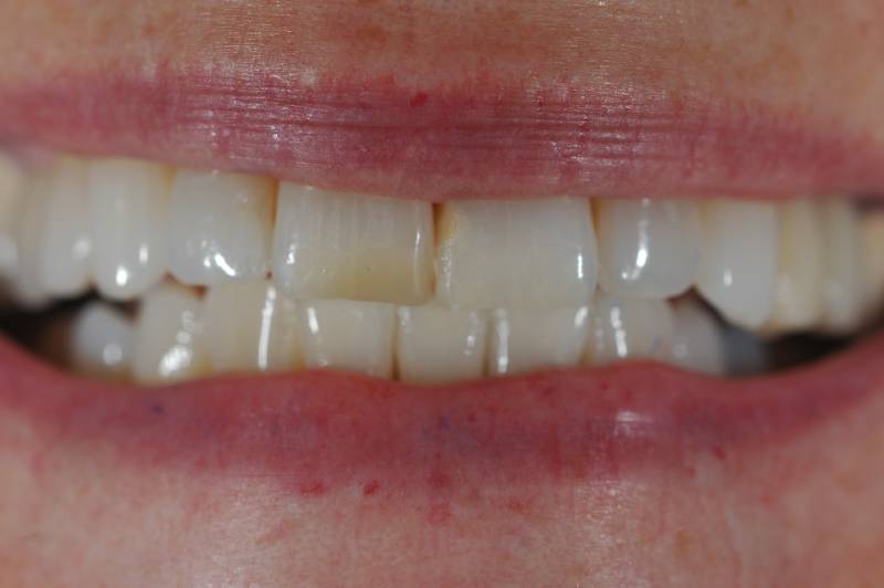 Before-photo of discolored upper front teeth with visible staining and wear.