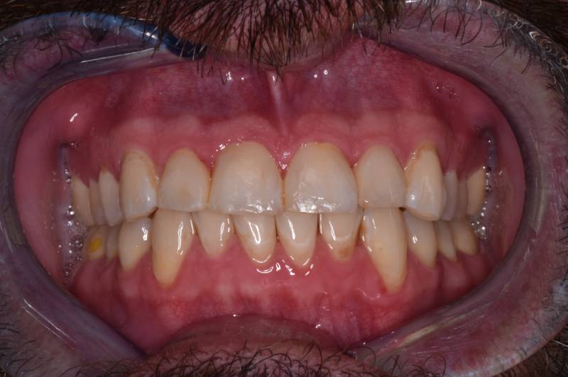 Hillcrest Dental dental restoration after treatment showing aligned teeth