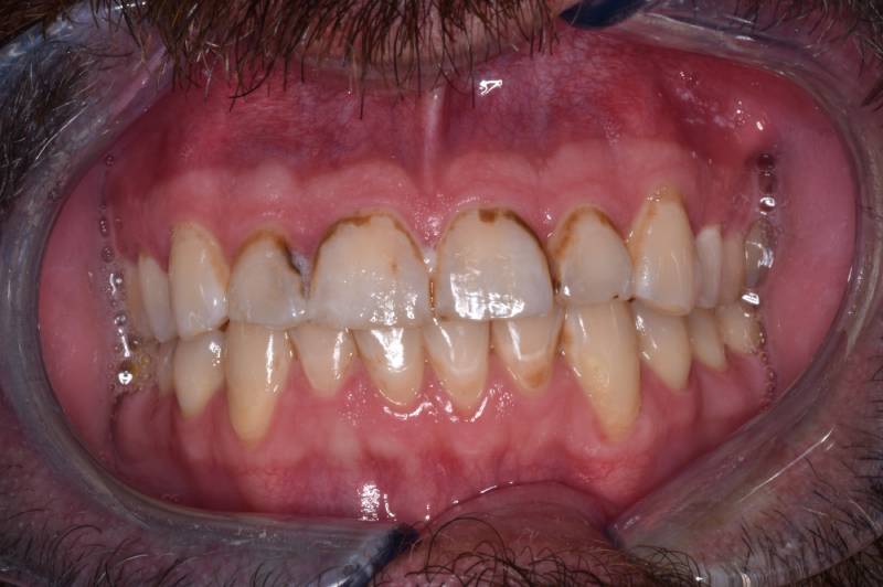 Before-photo of discolored and stained upper and lower teeth with visible wear.